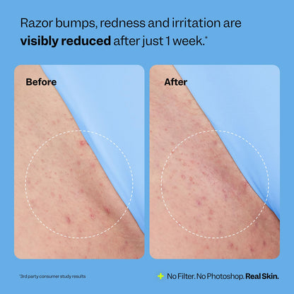 PLURA™ SmoothSkin Ingrown Hair Treatment