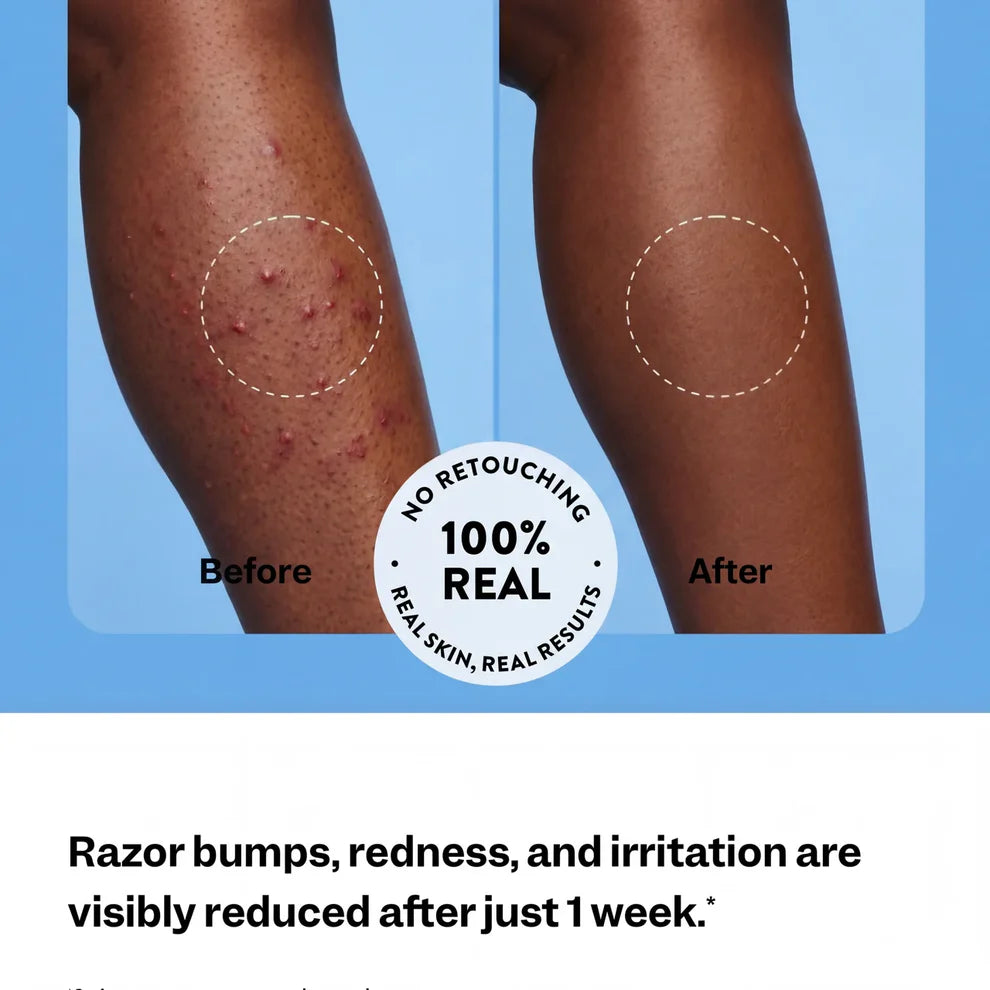 PLURA™ SmoothSkin Ingrown Hair Treatment