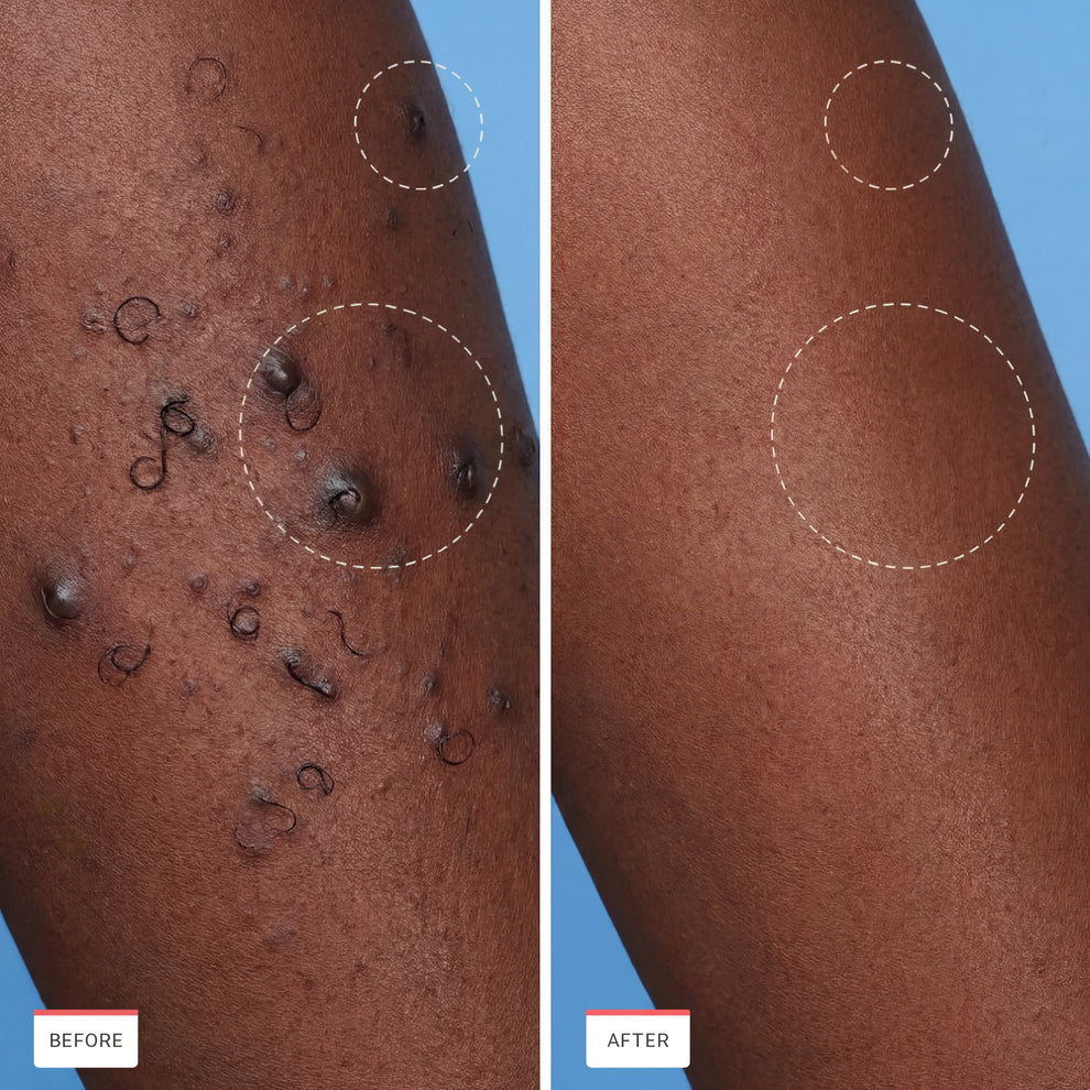 PLURA™ SmoothSkin Ingrown Hair Treatment